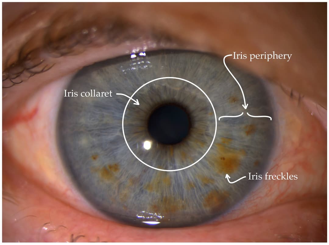 Example image for freckles